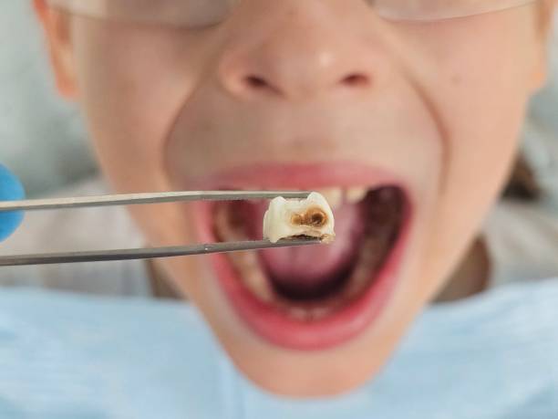 Best Dentist for Tooth Abscess  in Marengo, IL